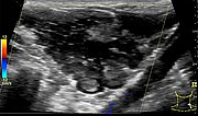 Farbkodierte Duplex Sonographie – Venöse Malformation am Hals