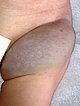 Non-Involuting Congential Hemangioma – Tumor in der linken Leiste (6. Monat)