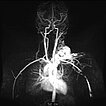 MR-Angiographie – Arteriovenöse Malformation an Hals/Thorax