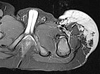 MRT – Non-Involuting Congential Hemangioma