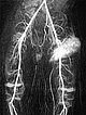 MR-Angiographie – Non-Involuting Congential Hemangioma (41s)