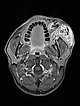 MRT – Arteriovenöse Malformation