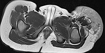 MRT – Non-Involuting Congential Hemangioma