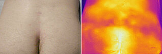 Infrarotthermographie  – Intramuskuläre venöse Malformation