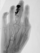 Embolisation – Arteriovenöse Malformation am Finger