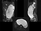 MRT – Lymphatische Malformation