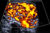 Dopplersonographie – Subkutanes infantiles Hämangiom