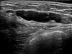 Ultraschall – Lymphatische Malformation an Bauchwand
