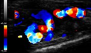 Farbkodierte Duplexsonographie – Arteriovenöse Malformation an Finger