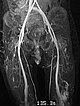 MRT – Genitale venöse Malformation am Labium majus