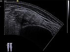 Sonographie – Venöse Malformation an Oberschenkel