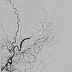 Digitale Subtraktionsangiographie – Stirn