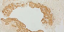 SMA-Färbung – Kombinierte venolymphatische Malformation