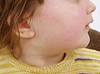 Infantiles Hämangiom an Hals –nach erfolgreicher Therapie