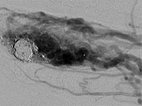 DSA – Arteriovenöse Malformation am Finger