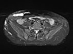 MRT – Lymphatische Malformation an Bauchwand