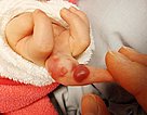 Säugling mit einem progredienten, roten, pulsatilen Tumor am Finger
