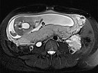 MRT – Venöse Malformation des Abdomens