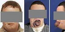Venöse Malformation – Mund- Rachenraum