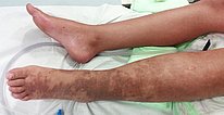 Parkes-Weber-Syndrom am Bein – nach Therapie