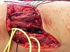 Operation – Fibro Adipose Vascular Anomaly an Wade