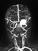 MR-Angiographie – Infantiles Hämangiom an Auge