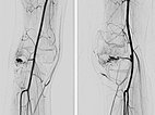 DSA – PTEN-Hamartom-Syndrom am Knie