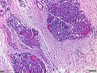 Kaposiformes Hämangioendotheliom – Histologie