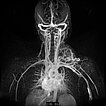 MR-Angiographie – Arteriovenöse Malformation an Hals/Thorax