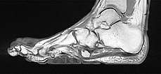 MRT – Proteus-Syndrom