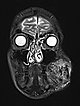 MRT – Arteriovenöse Malformation