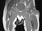 MRT – Non-Involuting Congential Hemangioma