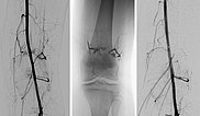 Embolisation – Parkes-Weber-Syndrom am Bein