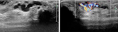 Sonographie – Arteriovenöse Malformation am Finger