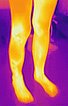 Infrarot-Thermographisches Foto – PTEN-Hamartom-Syndrom am Knie