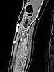MRT – Venöse Malformation an UnterarmT1-gewichtete, fettgesättigte KM-unterstützte MRT-Sequenz des Unterarmes. Man sieht klar das komplette Enhancement der Malformation in der Muskulatur. Damit handelt es sich um eine venöse Malformation. Einige etwas vergrößerte, dysplastische Venen finden sich auch lateral am proximalen Unteram epifaszial im subkutanen Fettgewebe.