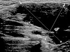 Sonographie – Venöse Malformation am Hals