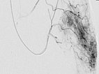 Digitale Subtraktionsangiographie – Non-Involuting Congential Hemangioma