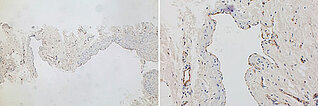 Immunhistologische CD31-Färbung – Kombinierte venolymphatische Malformation