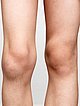 PTEN-Hamartom-Syndrom mit arteriovenöser Malformation – Knie