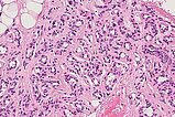 Histologie HE-Färbung – Subkutanes infantiles Hämangiom
