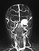 MR-Angiographie – Infantiles Hämangiom an Auge