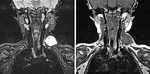 MRT – Venöse Malformation am Hals