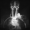 MR-Angiographie – Arteriovenöse Malformation an Hals/Thorax