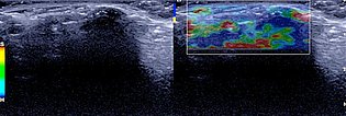 Ultraschall-Elastographie – Proteus-Syndrom