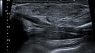 Sonographie – Subkutanes infantiles Hämangiom