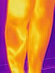 Infrarot-Thermographiebild – PTEN-Hamartom-Syndrom am Knie nach Resektion