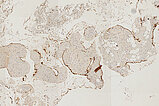Histopathologie CD31-Färbung – Intramuskuläre venöse Malformation