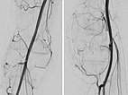 DSA – PTEN-Hamartom-Syndrom am Knie