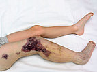Nach Sklerosierung – Klippel-Trénaunay-Syndrom, Lymphorrhoe am Bein